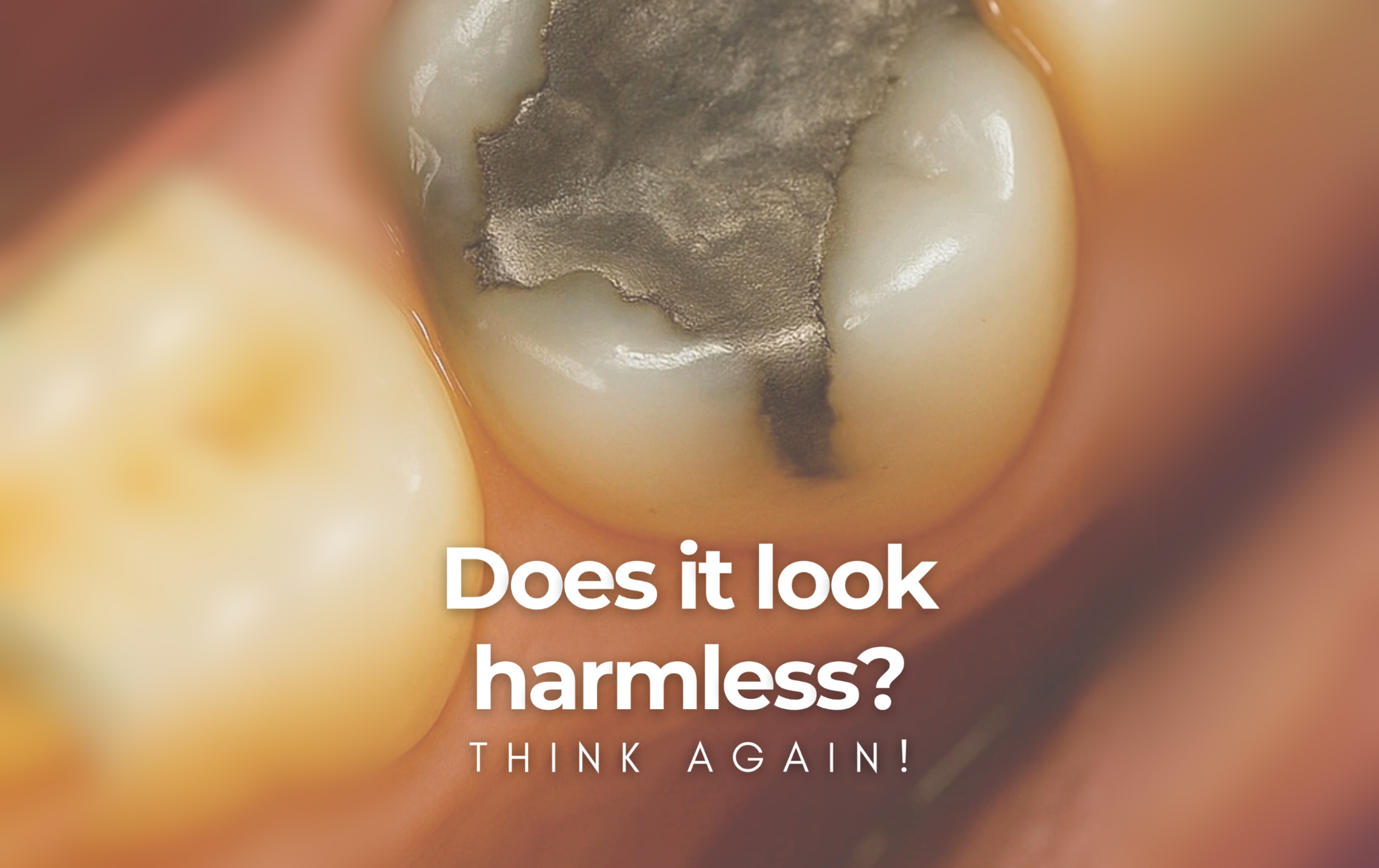 Amalgam thumb